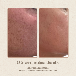 Improved skin texture and tone after CO2 laser resurfacing at Naturalness Med Spa in Murrieta