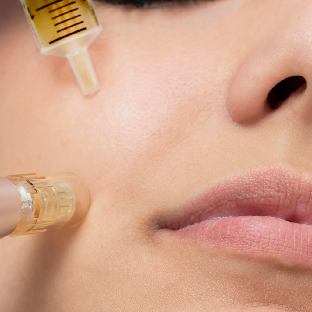 Close-up of microneedling device being applied to the skin at Naturalness Med Spa in Murrieta, CA